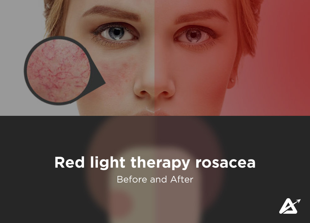 red-light-therapy-rosacea-before-and-after