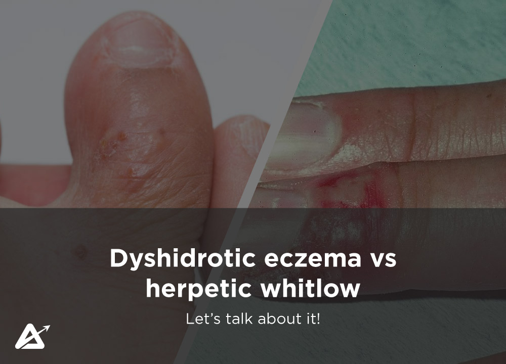 Dyshidrotic eczema vs herpetic whitlowDyshidrotic eczema vs herpetic whitlow
